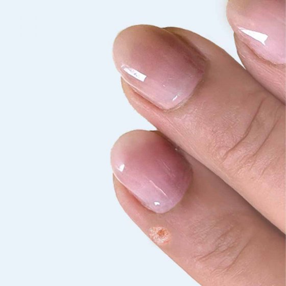  ‘Vaarwel wratten’-tinctuur 