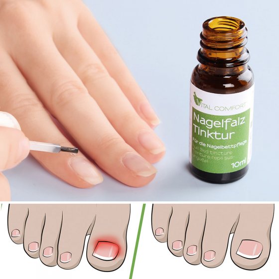 Nagelriem tinctuur 