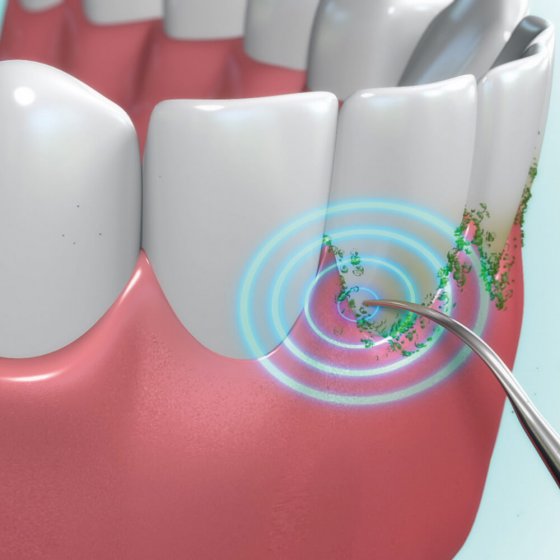 'Dental Pic Sonic'-tandenreiniger